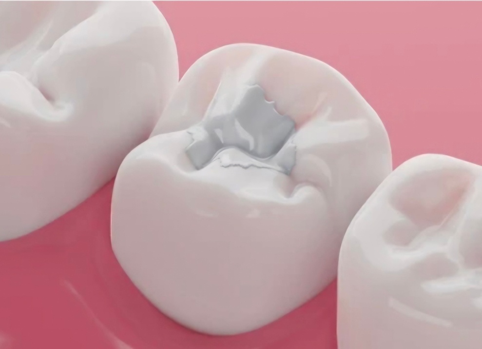 Azı dişi üzerinde eski dolgu alanını gösteren dental model