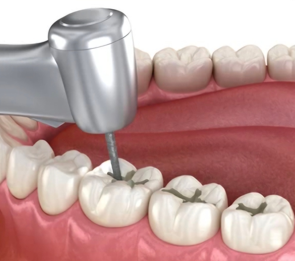 Eski dolgunun dişten kontrollü biçimde uzaklaştırılmasını gösteren dental çizim