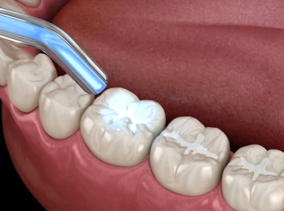 Azı dişine diş renginde dolgu materyali uygulanmasını gösteren dental çizim