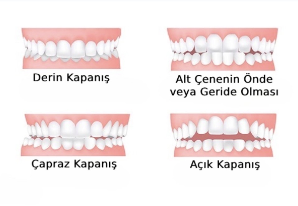 Derin kapanış, alt çene uyumsuzluğu, çapraz kapanış ve açık kapanış örnekleri