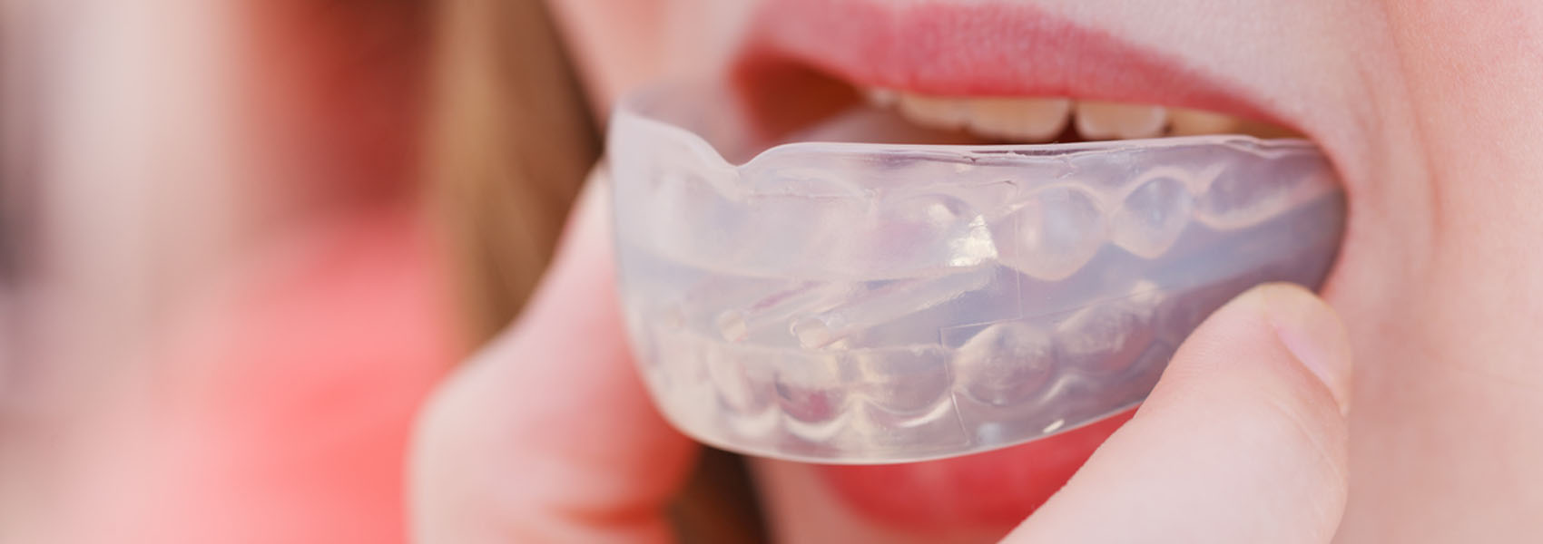 Clear Aligners