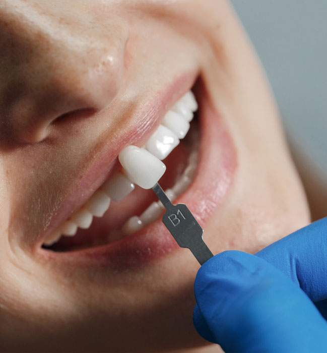 Root Canal Treatment