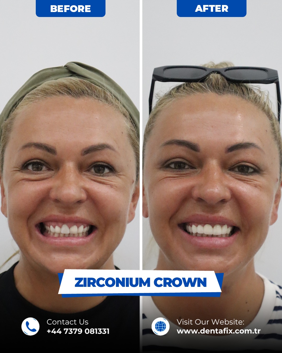 Zirkonyum kron Öncesi / Sonrası
