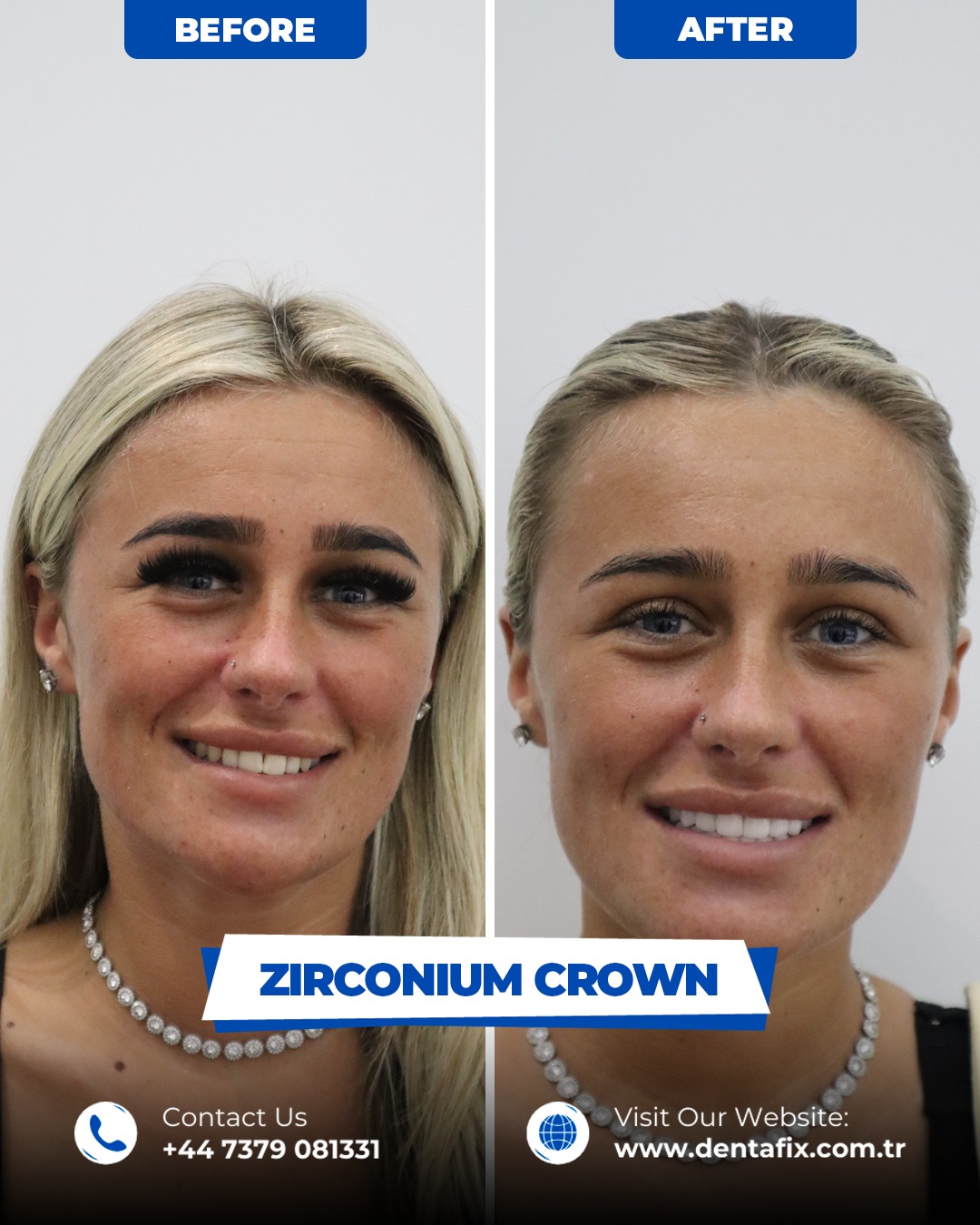 Zirkonyum kron Öncesi / Sonrası
