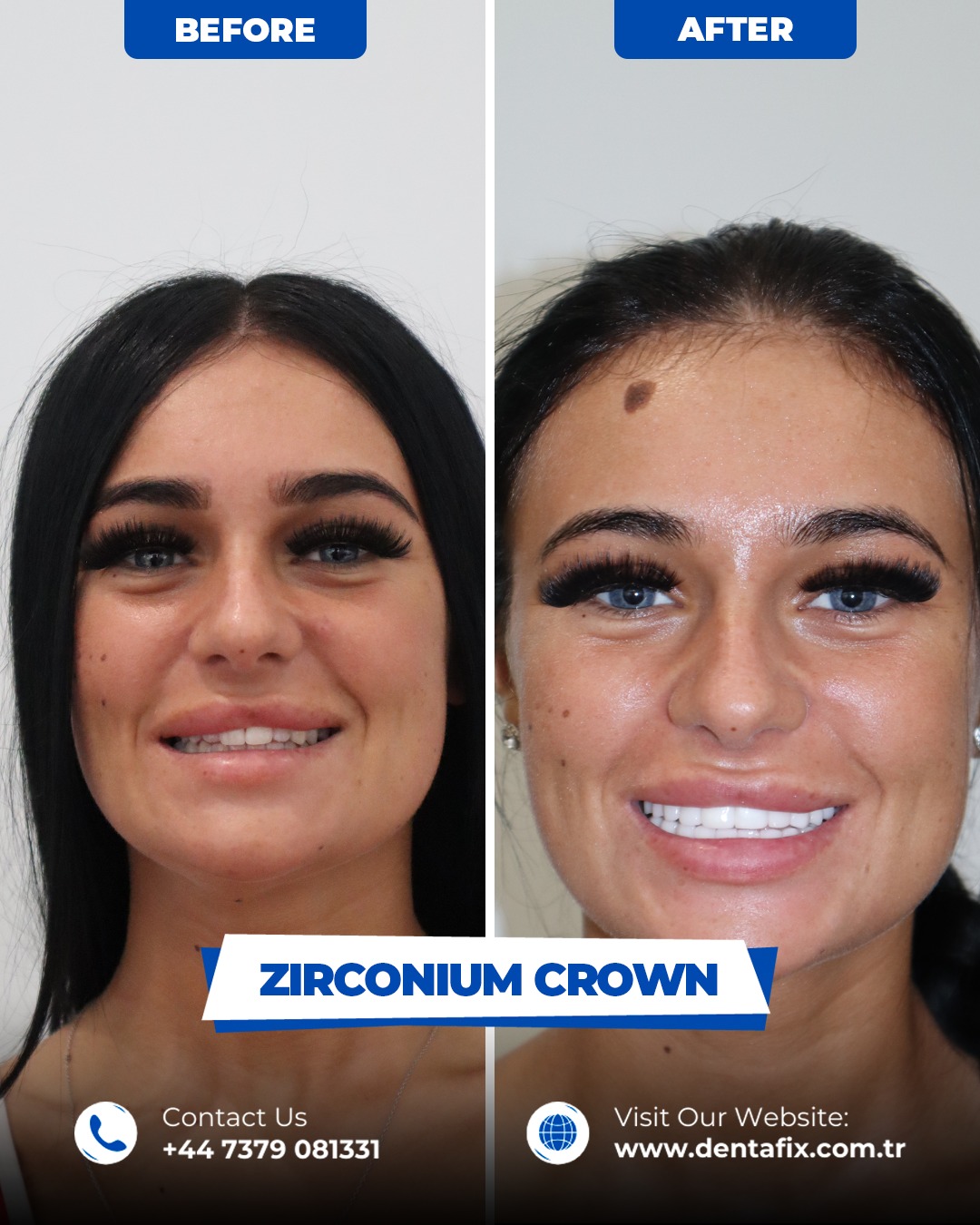 Zirkonyum kron Öncesi / Sonrası