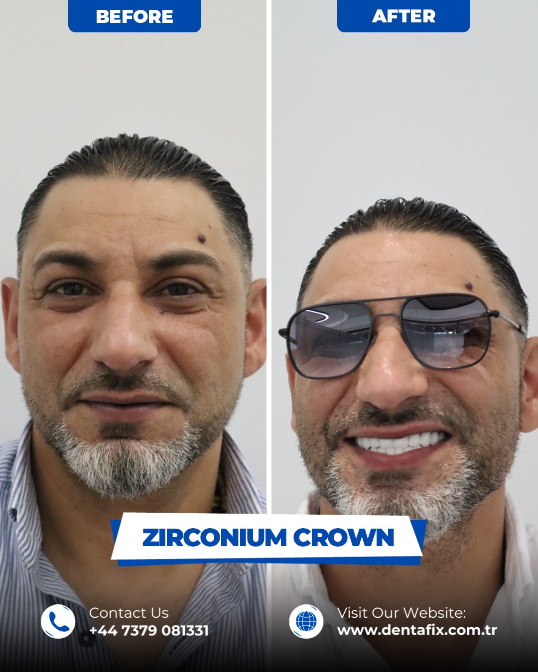 Zirkonyum kron Öncesi / Sonrası