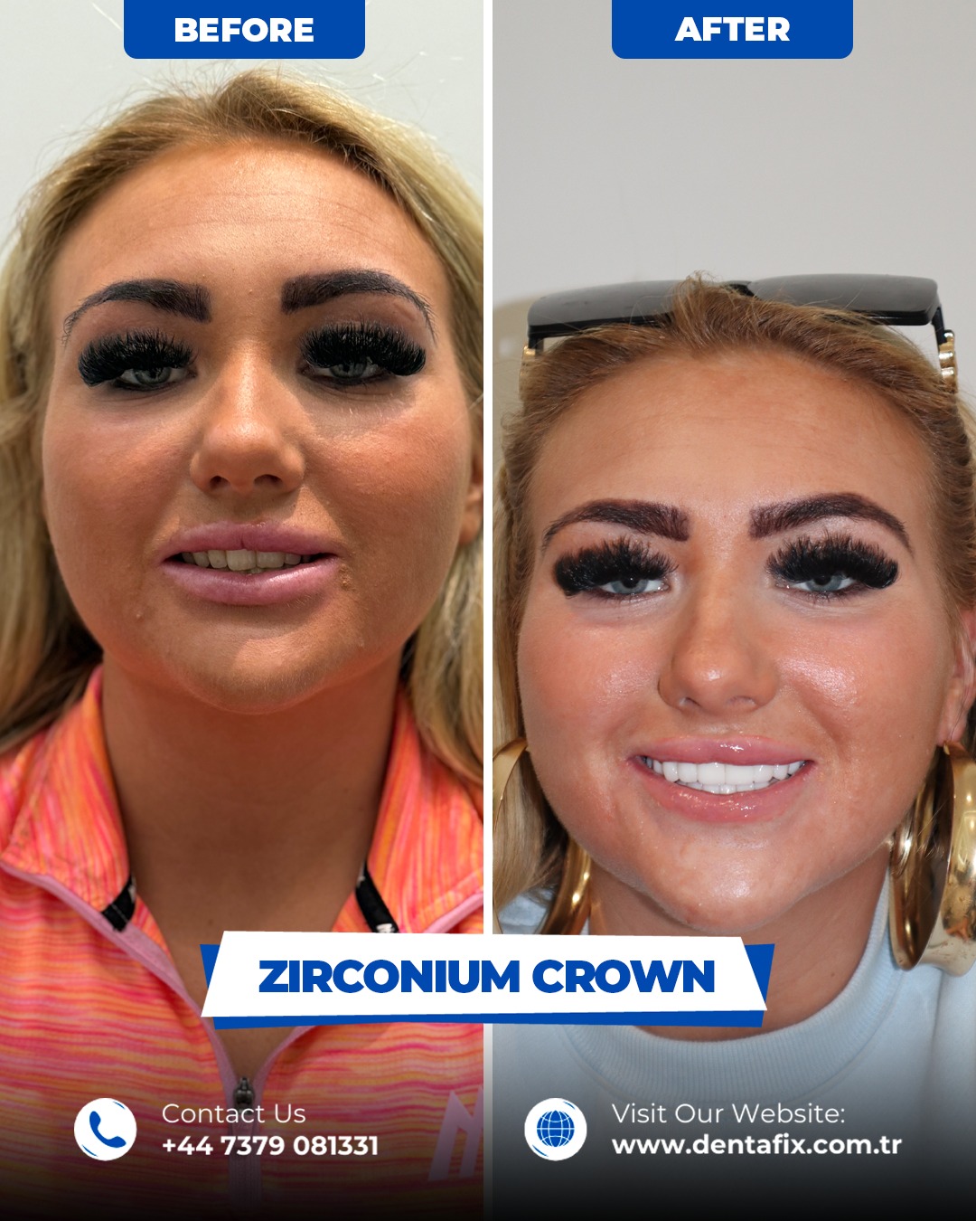 Zirkonyum kron Öncesi / Sonrası