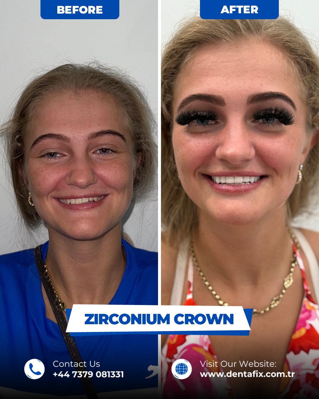 Zirkonyum kron Öncesi / Sonrası