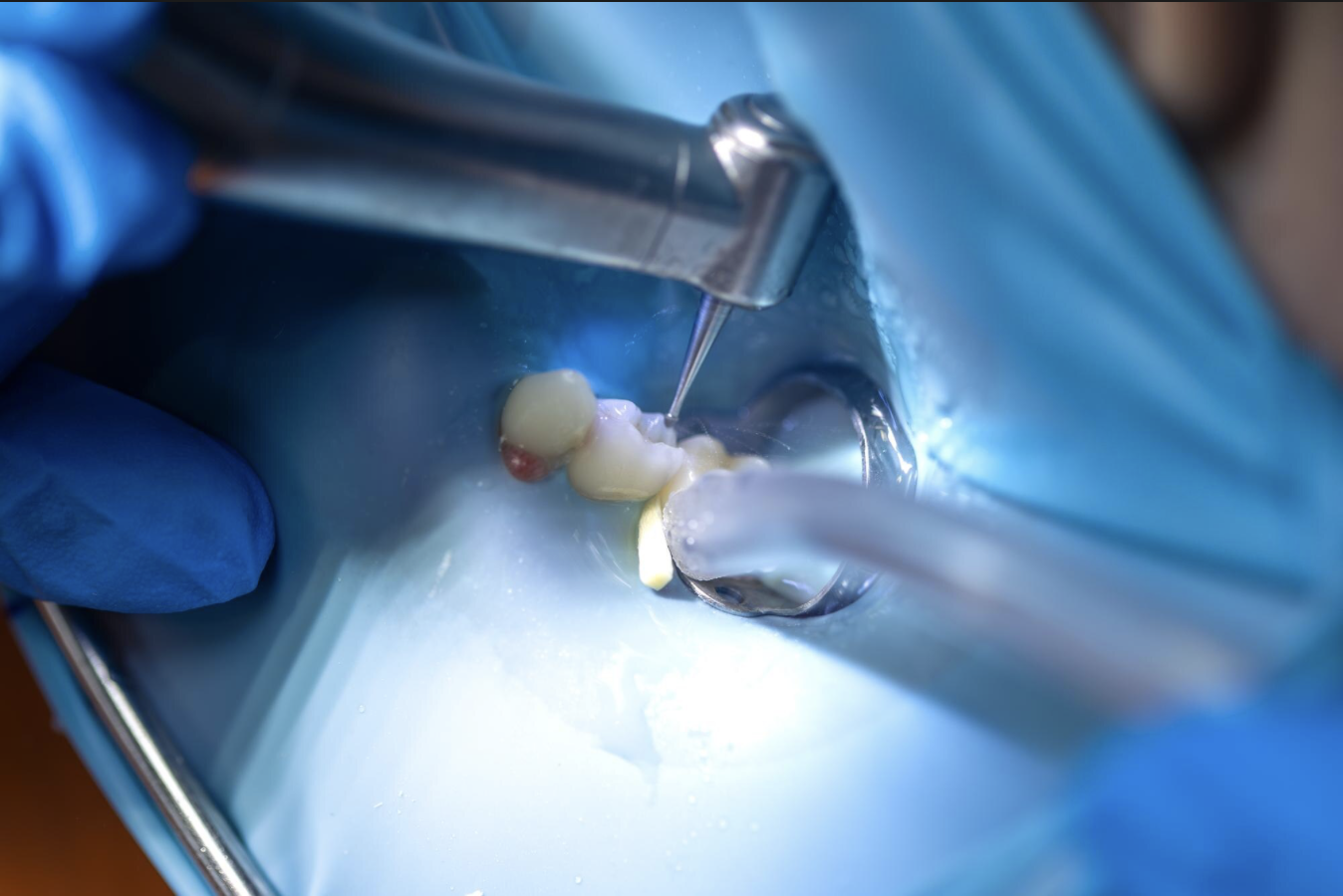 Diş Dolgusu 3D dental render