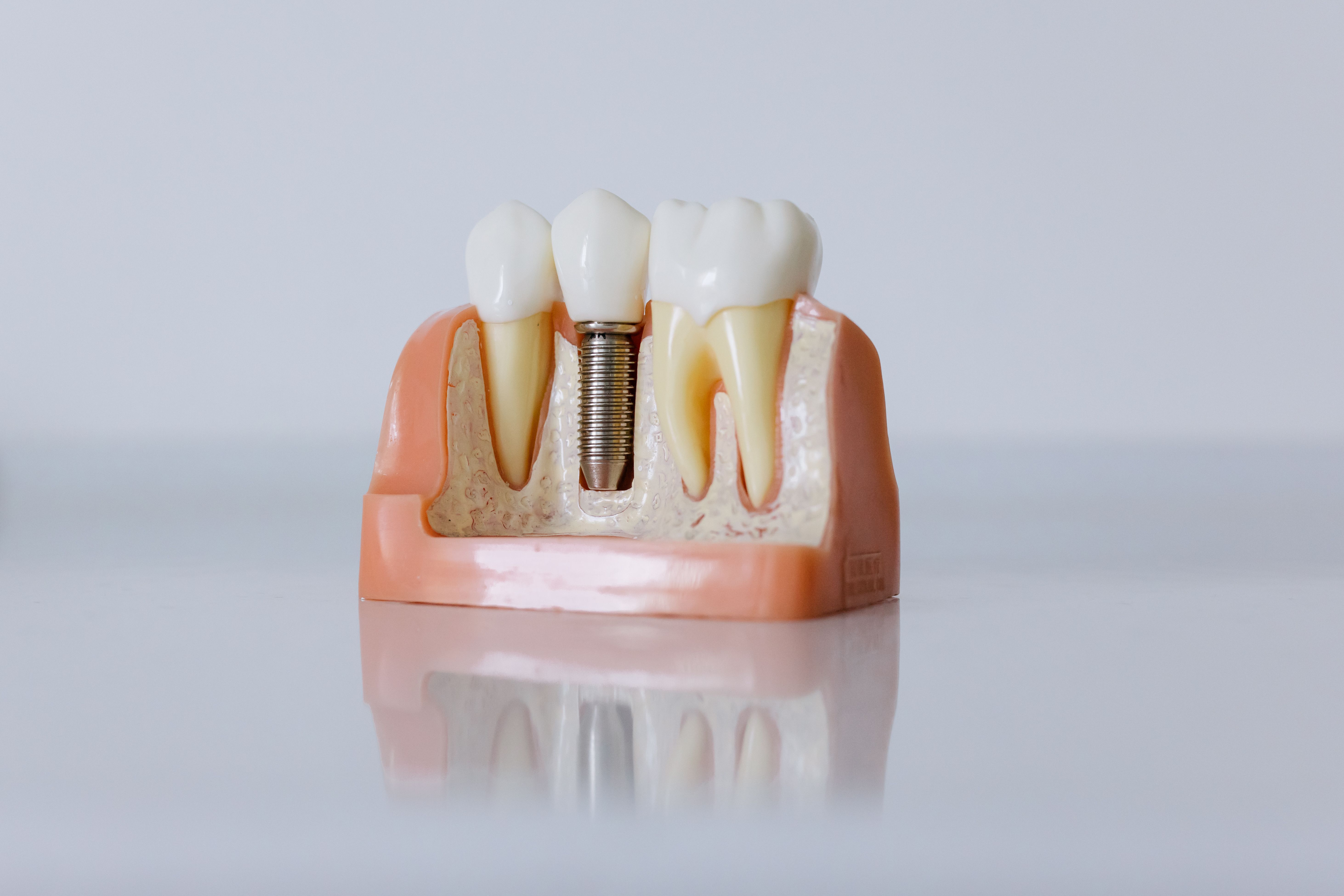 İmplantlar 3D dental render