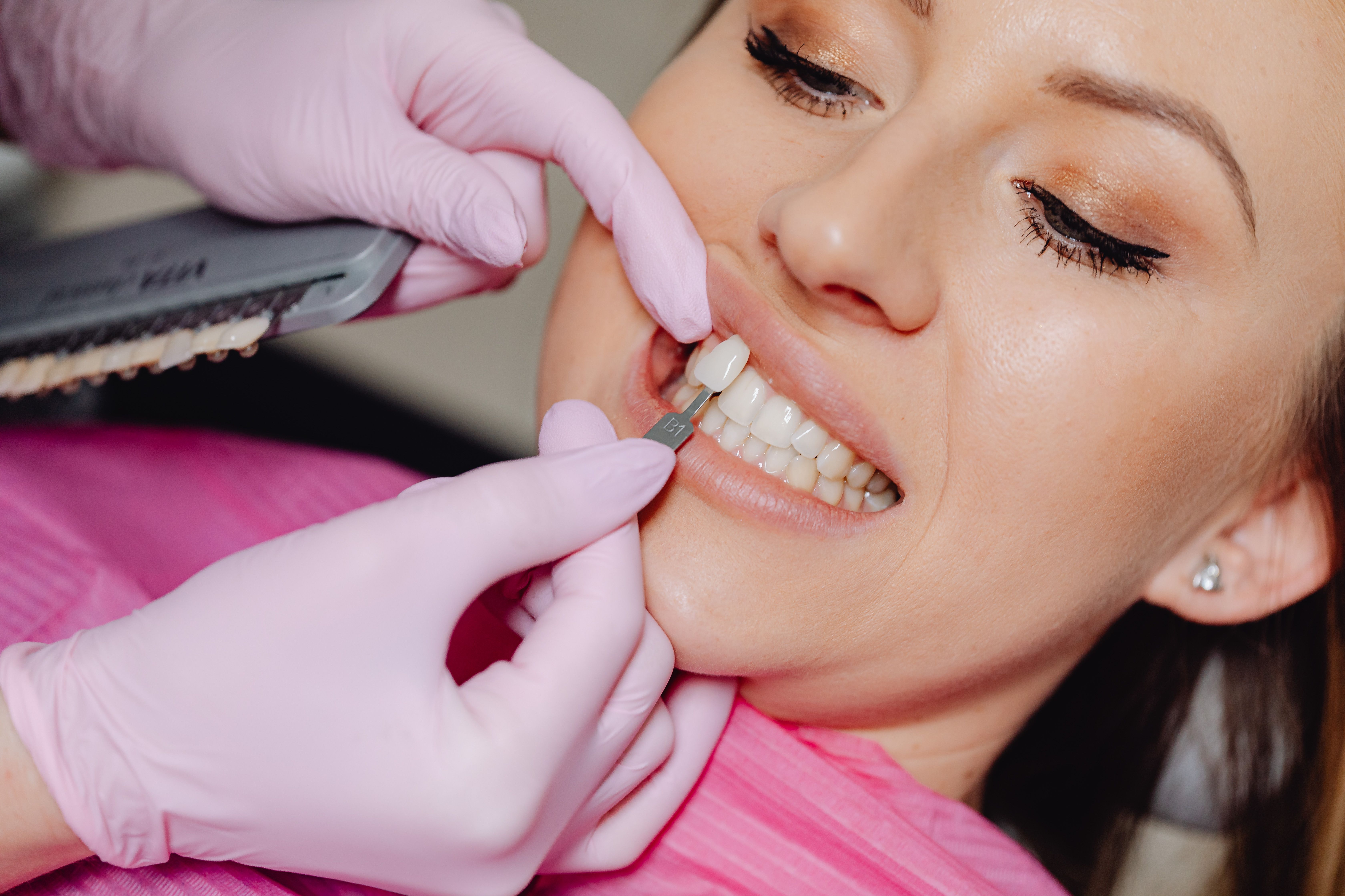 Emax Kaplama 3D dental render