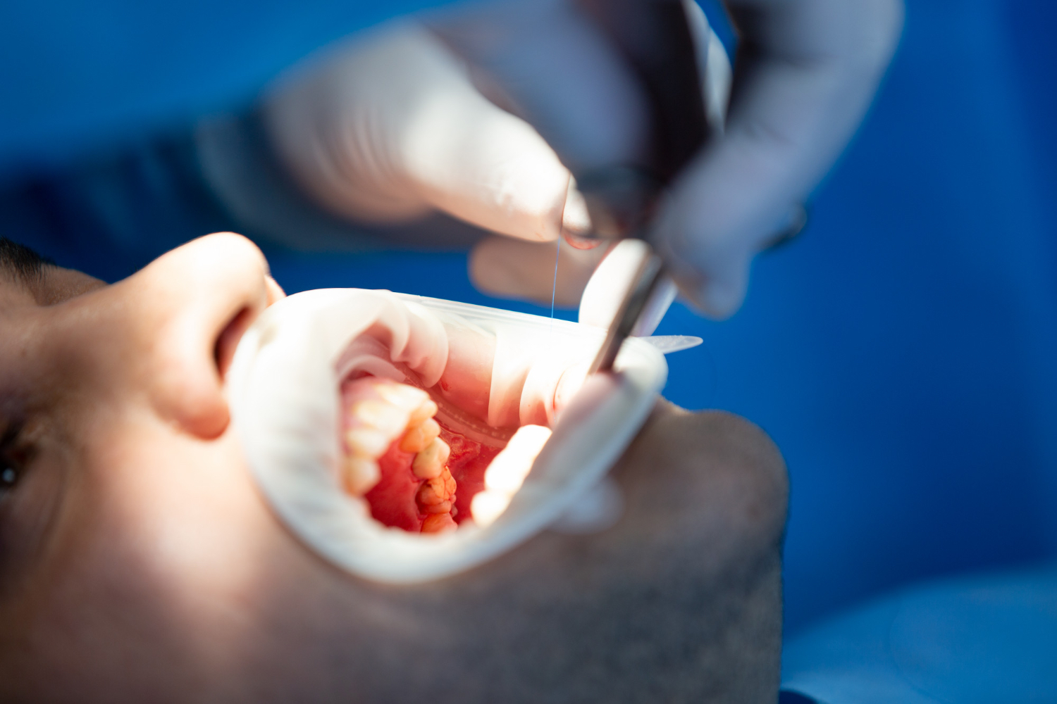 İnley ve Onley Dolgular 3D dental render