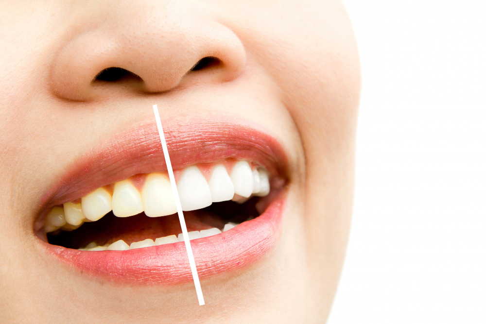 Diş Beyazlatma 3D dental render